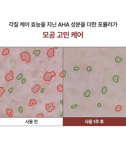 다양한 모공 고민을 한번에 해결해주며 각질 케어 효능을 지닌 AHA 성분이 함유된 피지흡착모공팩. 피부자극 테스트를 완료한 저자극 크리미 텍스처의 사용감. 모공 면적, 블랙헤드, 피부결, 각질 등 케어해주는 이니스프리 수퍼 화산송이 모공팩