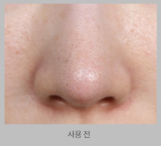 제품 사용 전 코 블랙헤드 사진