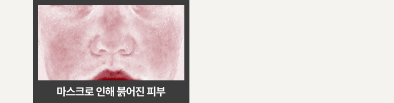 마스크로 인해 붉어진 피부 사진