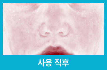 사용 직후 완화된 피부 사진