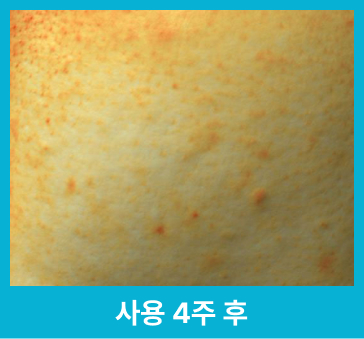 사용 4주 후 완화된 피부 잡티 사진