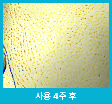 사용 4주 후 줄어든 모공 확대 사진