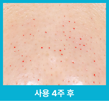 사용 4주 후 줄어든 블랙헤드/화이트헤드 확대 사진